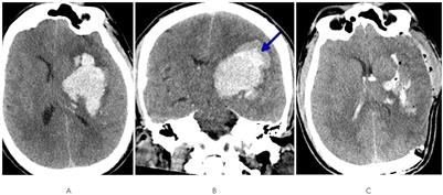 A review of methamphetamine use and stroke in the young